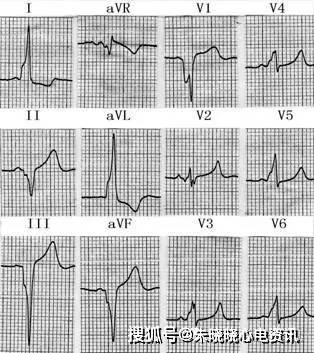 心室预激心电图分型图片