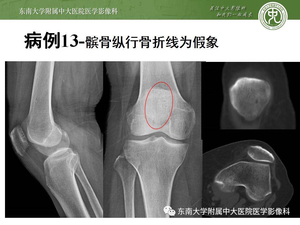 急诊必看 22个四肢骨关节外伤x线易漏诊病例 平台