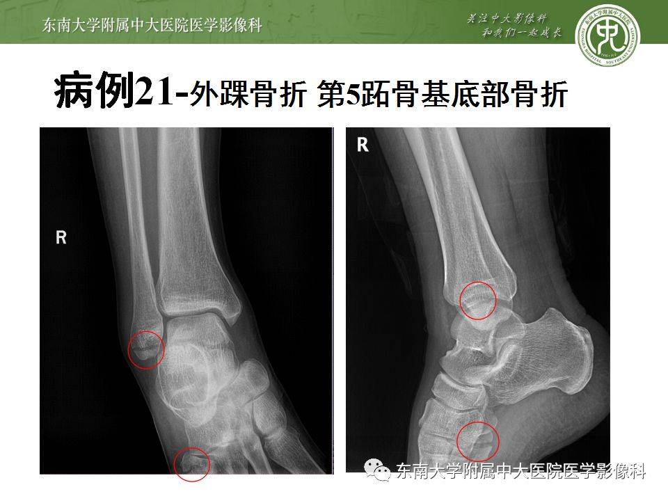 急诊必看 22个四肢骨关节外伤x线易漏诊病例 平台