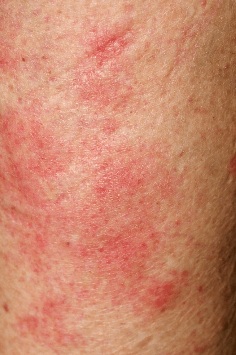 血热型表现症状:皮疹红色,遇热则加剧,得冷则减轻,多夏季发病,苔薄黄