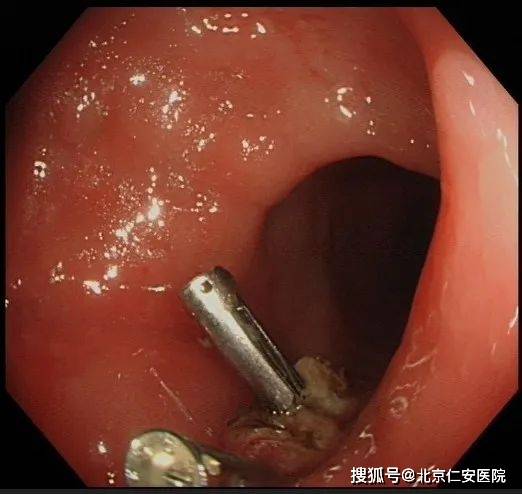 做胃腸鏡太難受無痛讓胃腸檢查成為一種享受