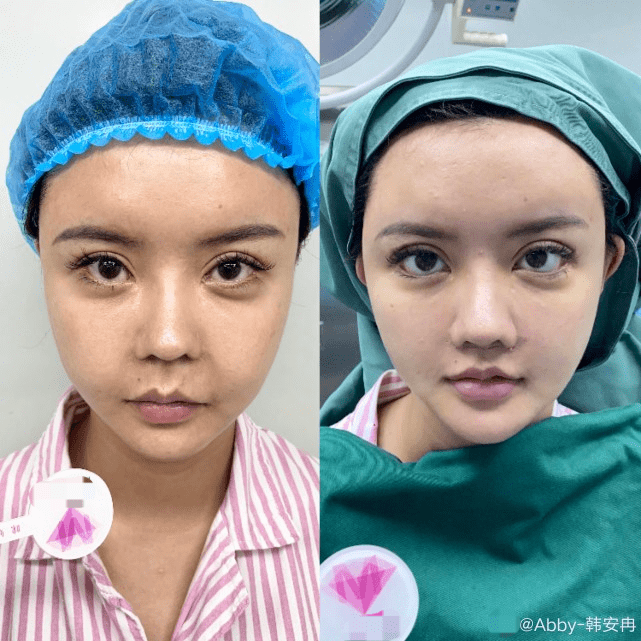 原创韩安冉出现整容后遗症下巴淤青明显假体还没融合好说话不利索