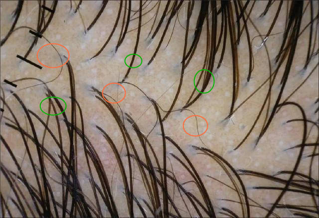 掉发,脱发,秃发,你是哪一种?_头发