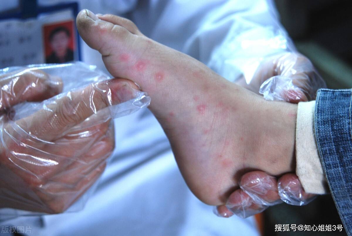 原创深圳进入手足口病高发期这个年龄段的孩子为高发人群要注意了