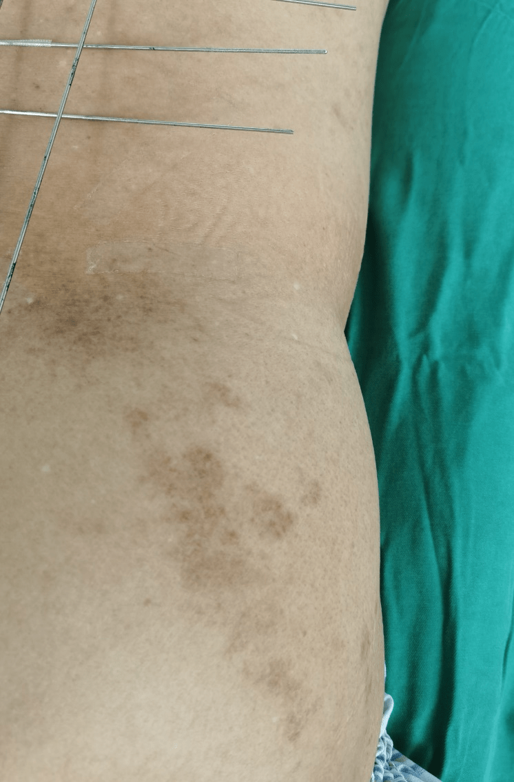 带状疱疹已经好了还是疼痛难忍怎么办