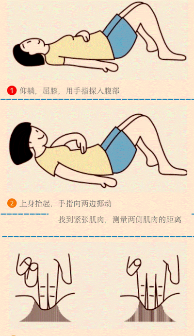 腹直肌分离自测腹壁无力,脏器移位,腹部膨出,这样身体重心前移.