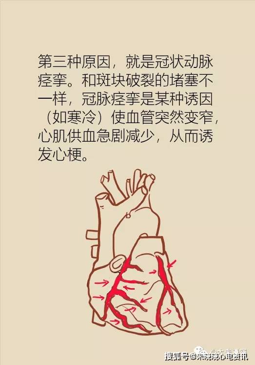 6大引起心梗猝死的原因你注意过吗