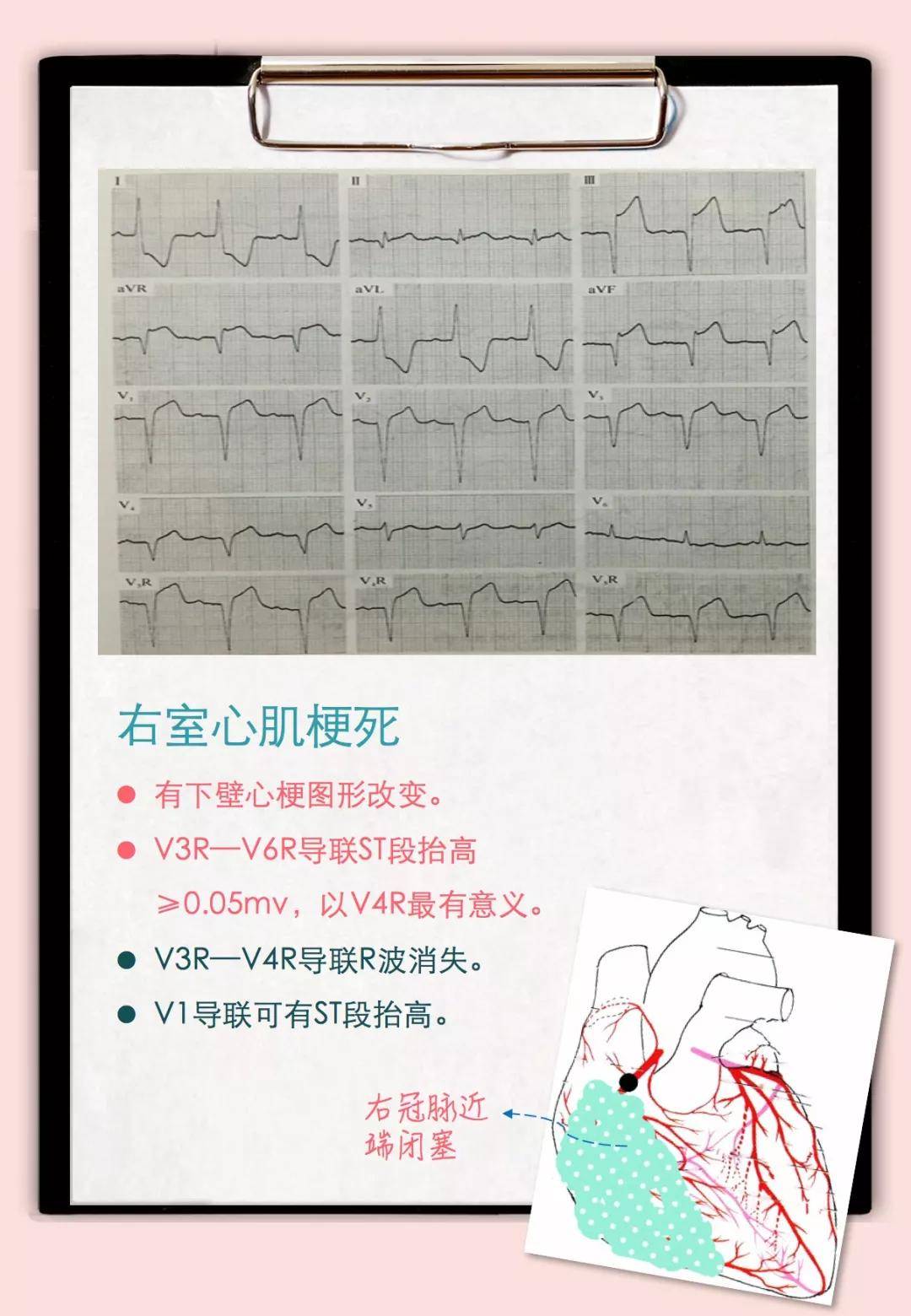 实用临床收藏冠状动脉供血不足急性心肌梗死心电图特点总结