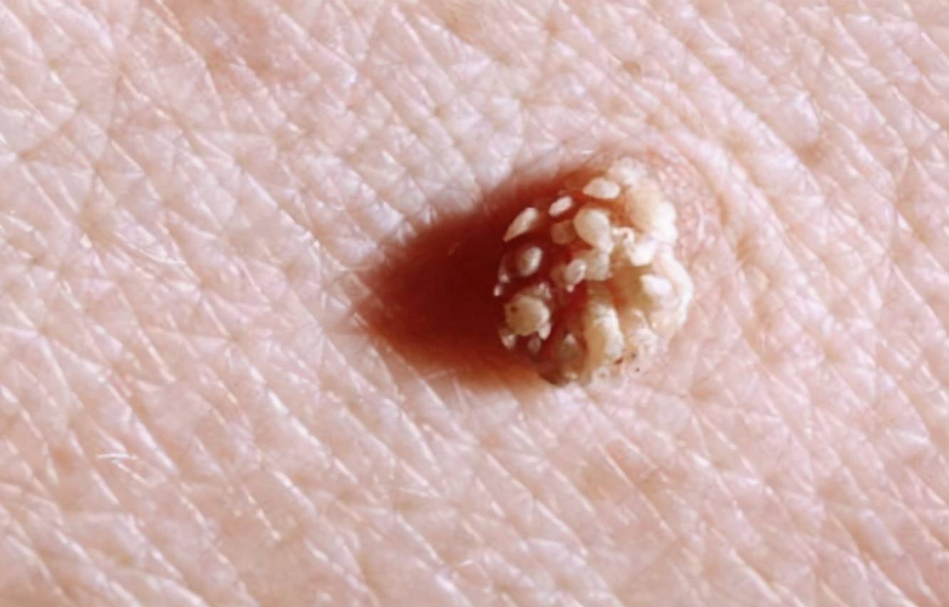 夏天女性手臂上长的淡红色小点,真的只是过敏?或与hpv有关