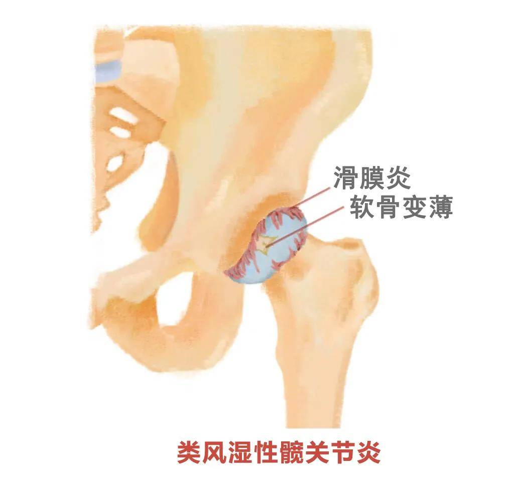 儿童单侧腹股沟疼（儿童腹股沟疼怎么回事）