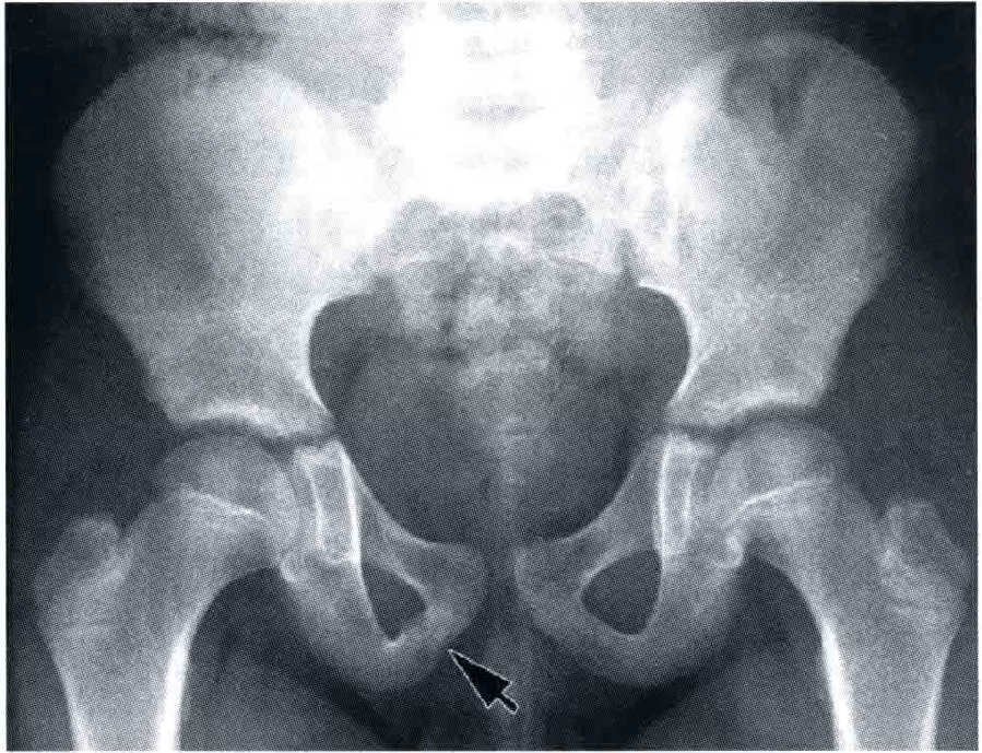 易误诊的骨盆假性骨折 正常骺线 软骨