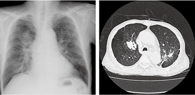 尘肺病人的肺图片