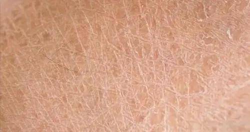 你有毛周角化症吗?
