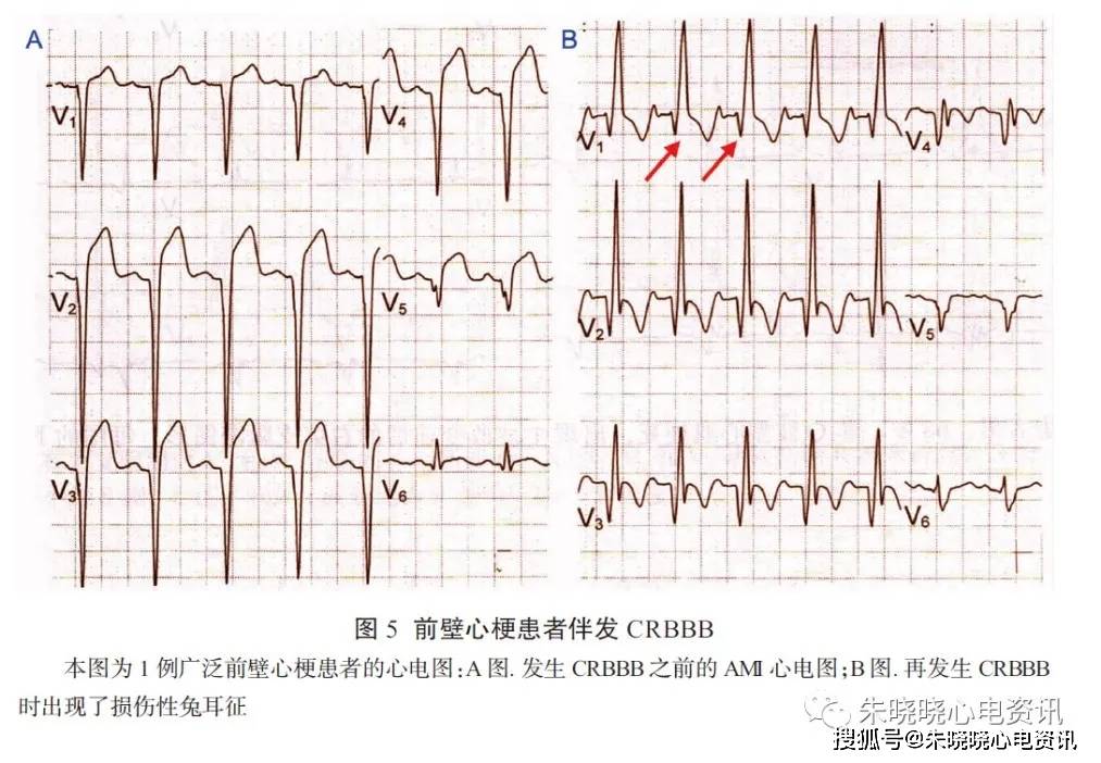 一文总结clbbb ami 的心电图诊断,值得一看!_束支