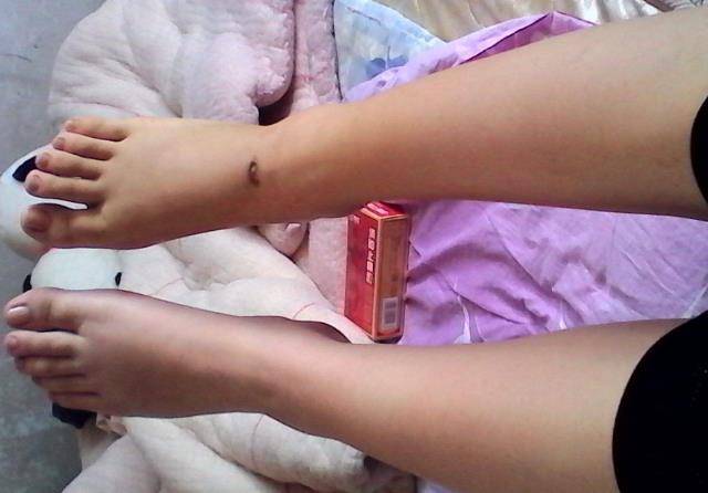 骨折一定要喝骨头汤吗伤筋动骨100天怎么做才能好的更快