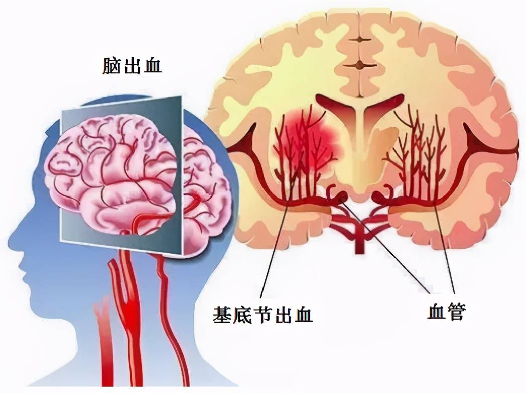 高血壓腦出血神志昏迷急診骨瓣開顱血腫清除減壓