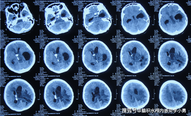 脑室再次扩张(图-8,拔除腰大池引流,给予左侧脑室外引流术(片子丢失)