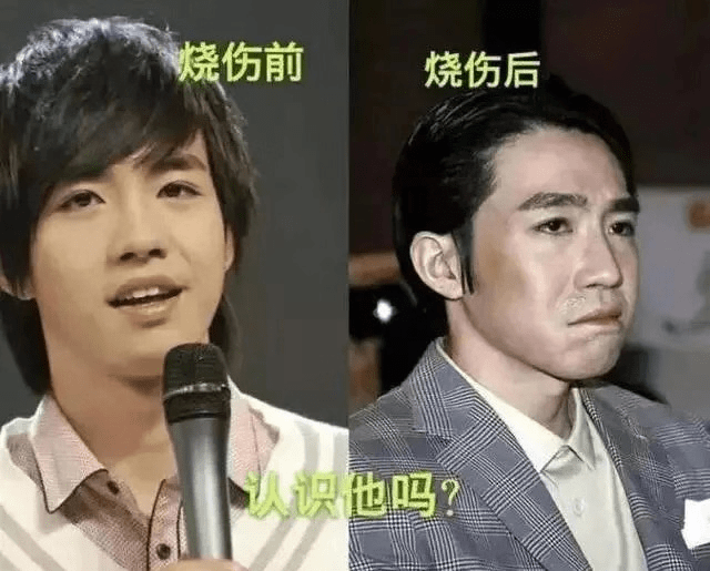 与俞灏明有些类似,戏骨谢君豪也在拍戏后,因为烧伤沦为了配角.