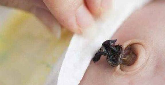 怎么护理新生儿脐带 7ae7945b6bca44679147b2aa3f1316da.jpeg