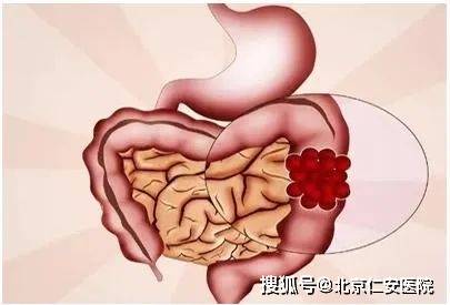 大腸癌患者早期會有大便不成形,大便帶黏液等症狀,這可能是合併存在的