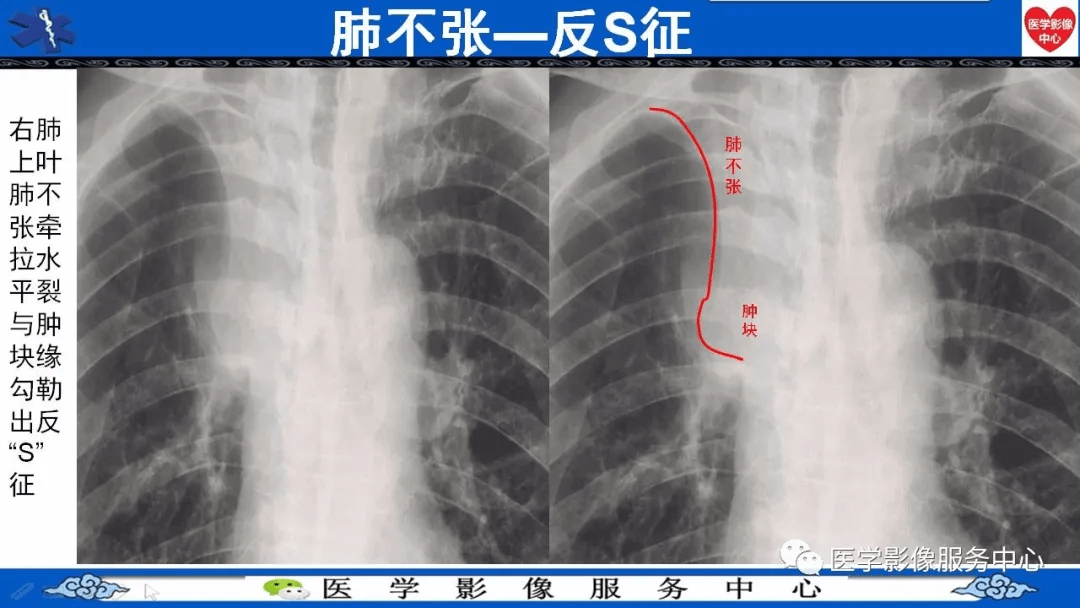 中央型肺癌影像学表现图片