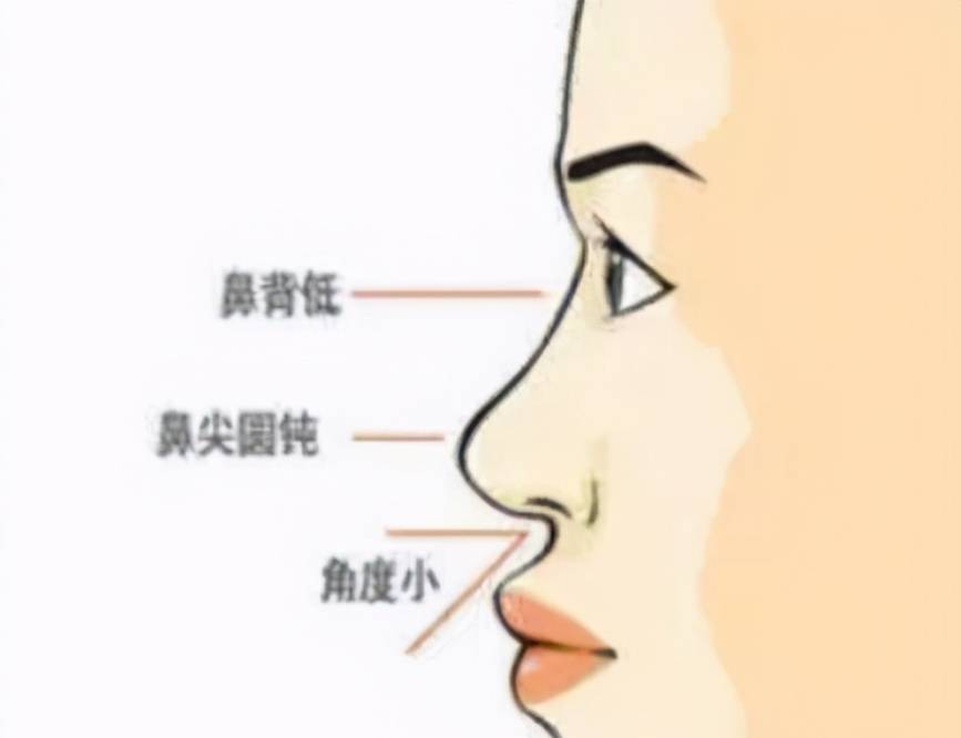 怎么知道自己是不是低鼻梁 2d286dba20b44275a099c5e0f853c05b.jpeg