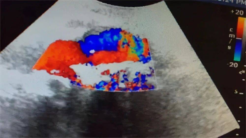 夹层|真性动脉瘤、假性动脉瘤、夹层动脉瘤特点及表现
