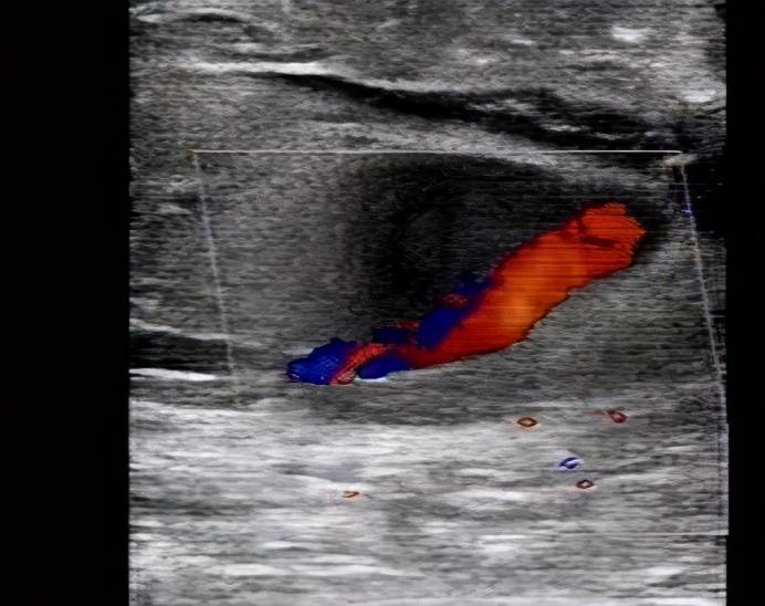 夹层|真性动脉瘤、假性动脉瘤、夹层动脉瘤特点及表现