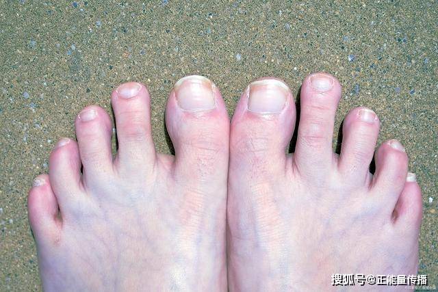 脚尖|血糖高不高，“脚部”先知？脚部这6种“症状”，希望你一个不占