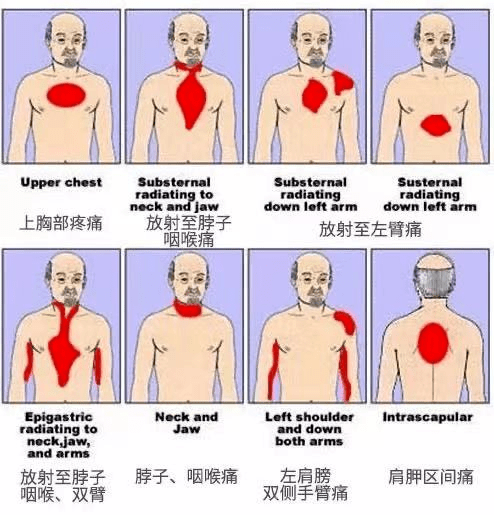 血管|【护心宝典6】什么是冠心病？