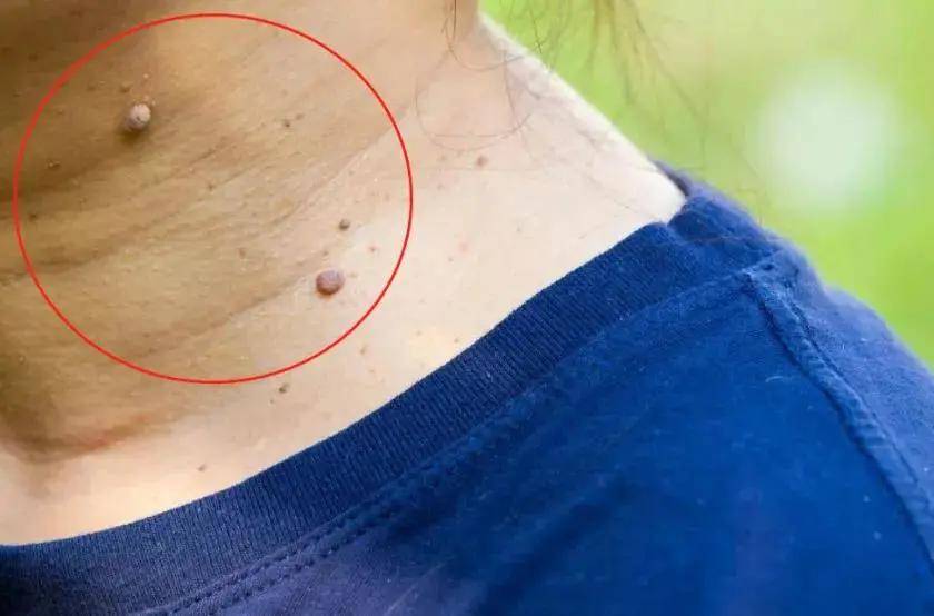 病毒|身上的瘊子是感染HPV，一个动作就会传给孩子！家里有娃的赶快看