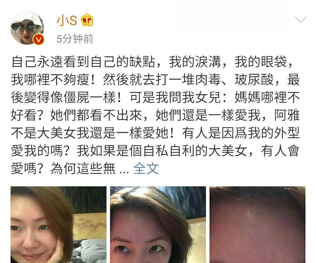 因为|小S发文承认打玻尿酸过度导致面瘫，连想笑都不能笑