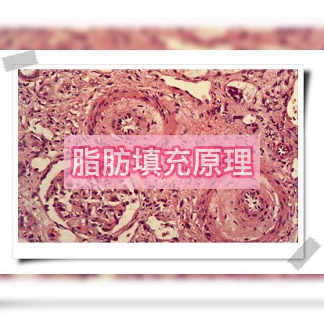 能量|面部脂肪填充维持多久？真人做过后的发言，这经必须得取！