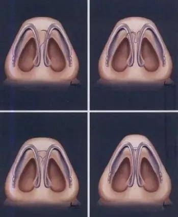 问题|给中年李嘉欣换上刘亦菲同款肉鼻头，会变什么样？