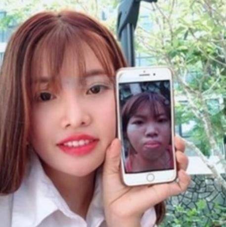 因为|越南女孩因长得丑遭嘲笑，整容后嫁给富豪，没成想孕期“现原形”