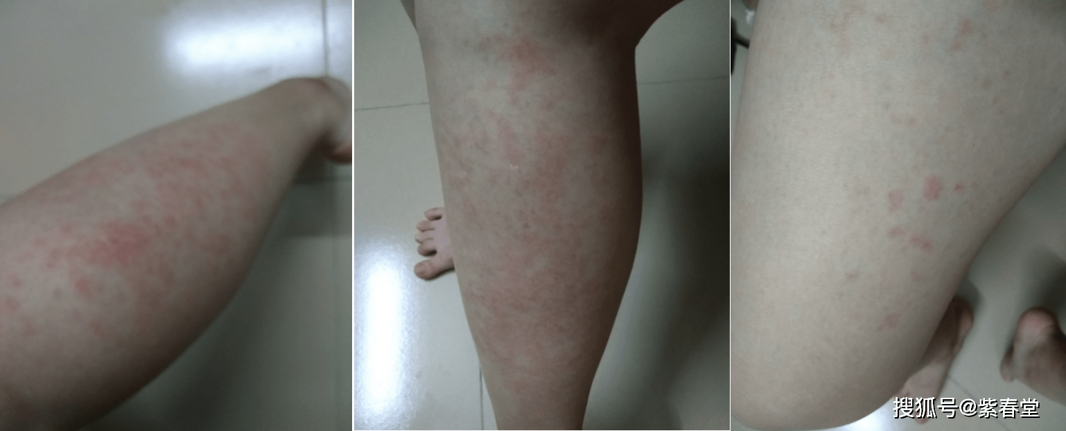 市里|過敏性紫癜腎炎必須做腎穿嗎？化驗檢查尿蛋白轉陰，怎么回事？
