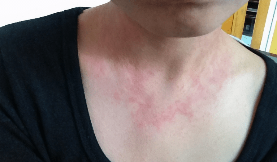 皮肤是hpv信号灯若皮肤出现2个异常建议尽早做筛查