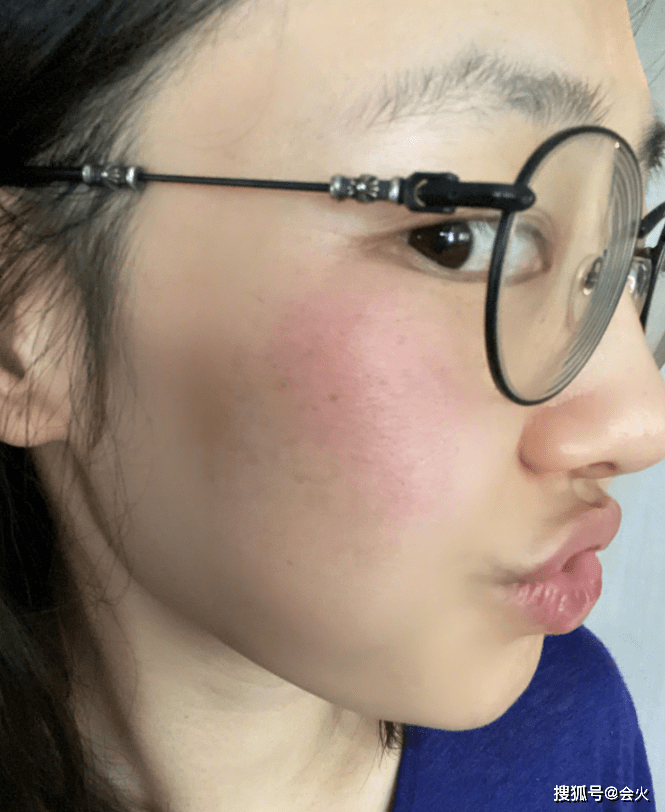 皮肤|白百何发晒伤自拍照！脸上发红一大片，镜头拉近后皮肤瑕疵明显