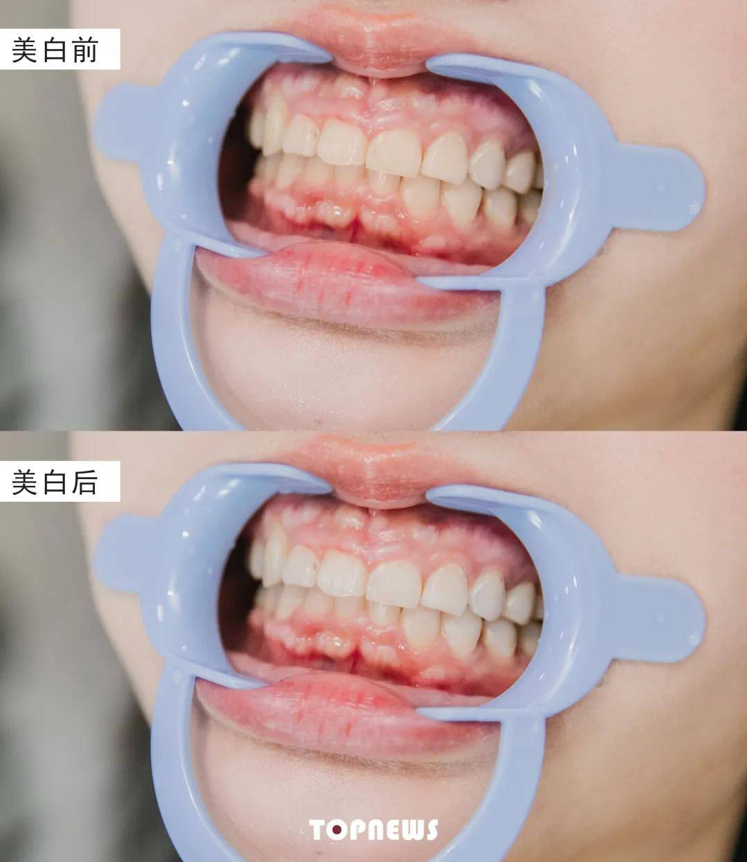 iTero|限时399元！抢千元“进口牙齿美白套餐”，拯救大黄牙！