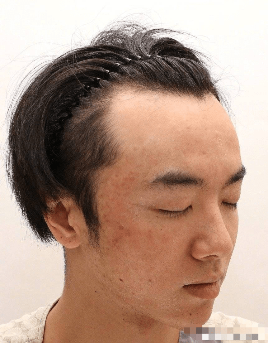 禁言|华晨宇被曝整容植发!前女友爆料!