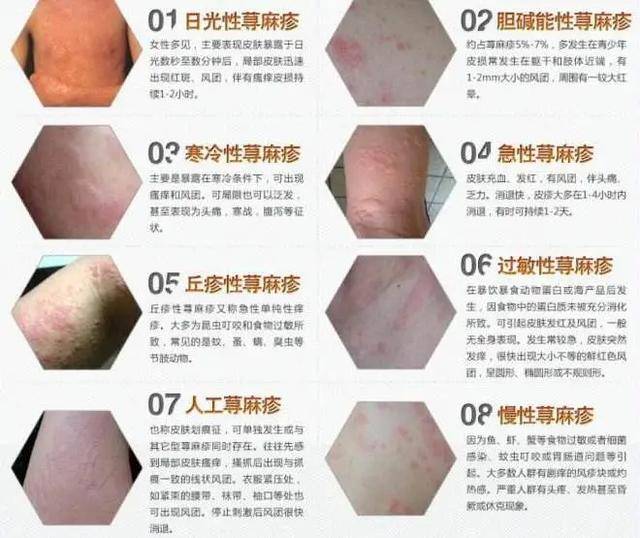 病毒,寄生虫等),劳累或精神紧张,内科疾病(sle,类风湿关节炎,淋巴瘤等