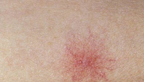 祸首|肝硬化的“祸首”被揪出，与饮酒无关，而是这种水果，要忌口