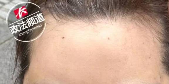 爱美|56岁大妈老来俏，贷款5万元整容，手术第二天就彻底“失控”