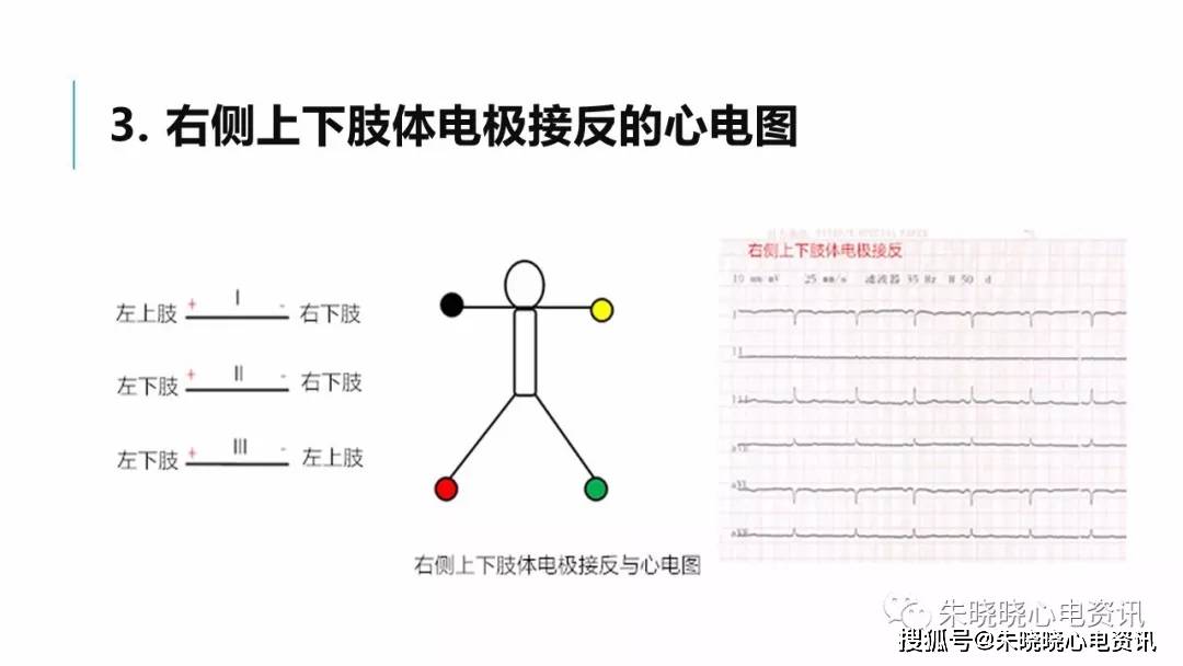 肢體導聯電極錯接心電圖分析及鑑別ppt