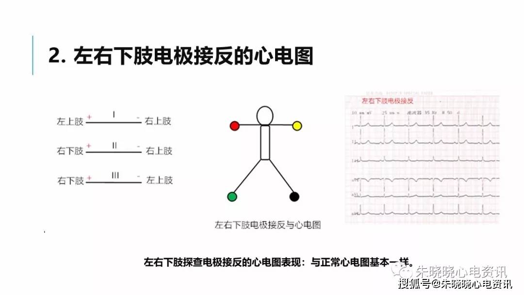 肢體導聯電極錯接心電圖分析及鑑別ppt