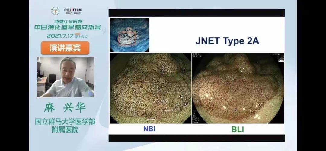 诊断|西安市红会医院消化内科成功举办首届中日消化道早癌交流会