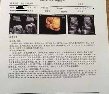 胎儿几个月可以查畸形 9fe47592694d4b169b73d449a69a5414.jpeg