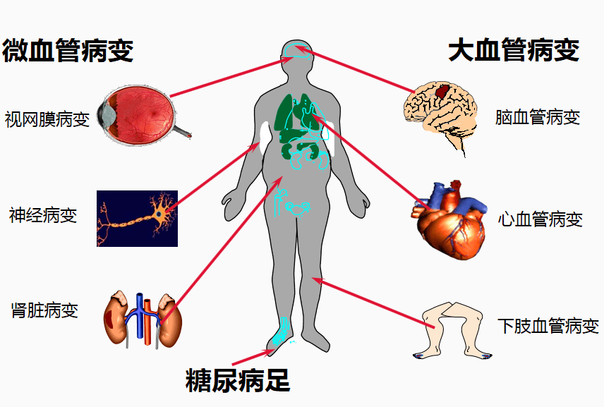 高血糖除了會導致急性併發症,還有更危險的慢性併發症.