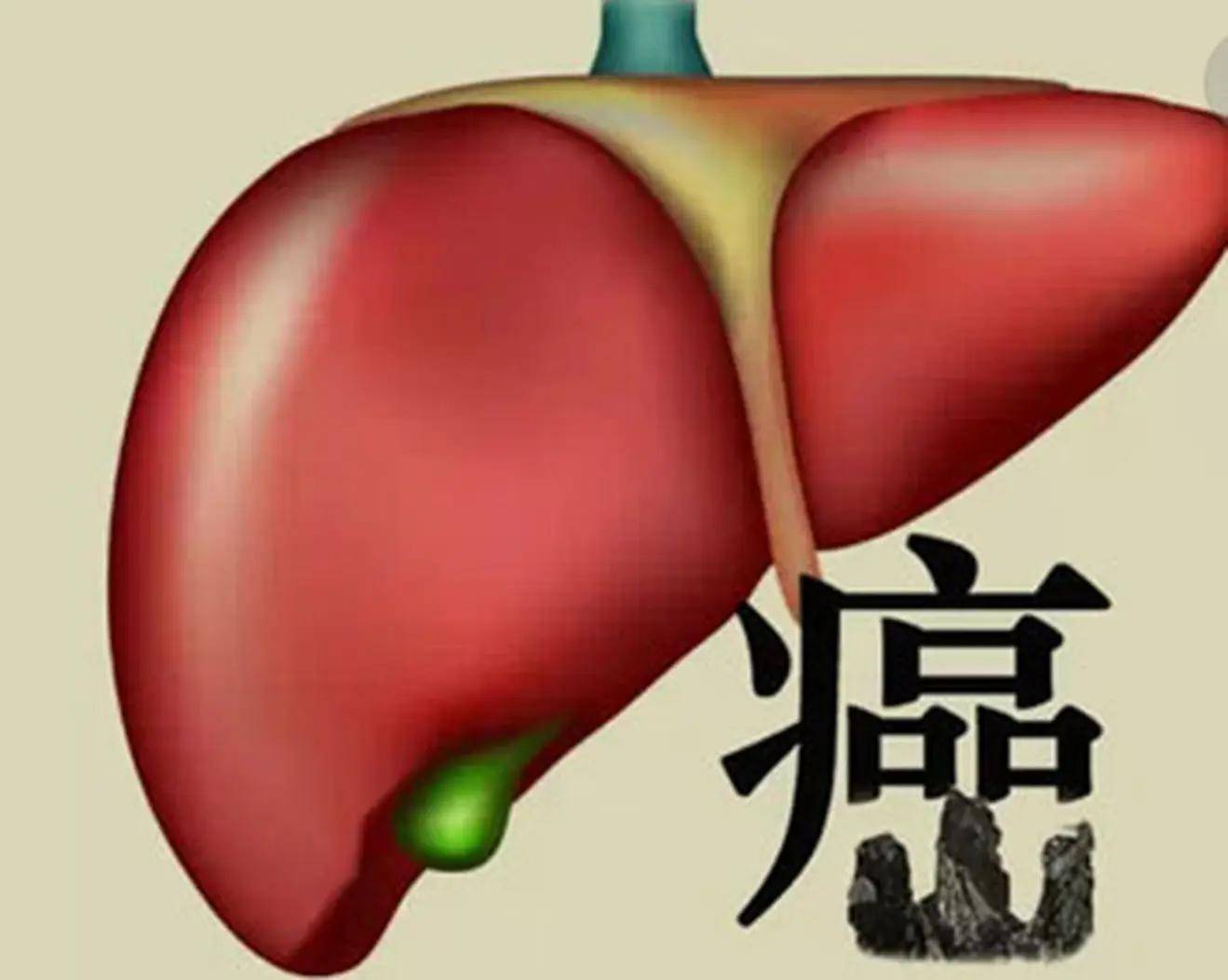 症状|从乙肝到肝癌，患者该如何规避肝癌风险？