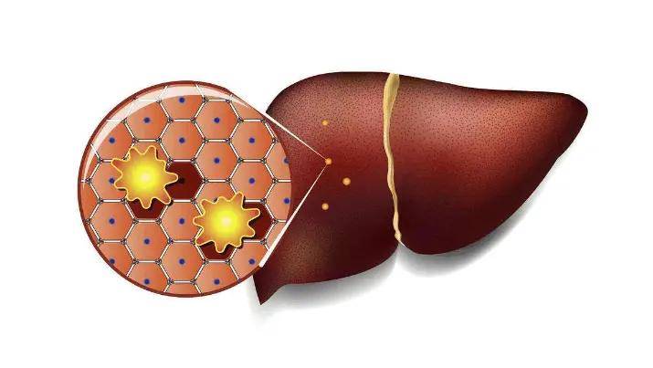 症状|从乙肝到肝癌，患者该如何规避肝癌风险？